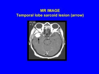  MR IMAGE  Temporal lobe sarcoid lesion (arrow)