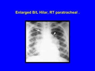 Enlarged B/L Hilar, RT paratracheal .