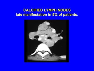 CALCIFIED LYMPH NODES late manifestation in 5% of patients.