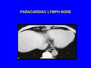 PARACARDIAC LYMPH NODE