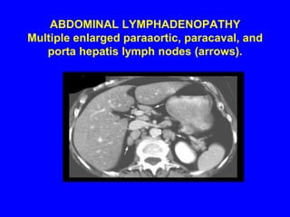 ABDOMINAL LYMPHADENOPATHY Multiple enlarged paraaortic, paracaval, and porta hepatis lymph nodes (arrows).