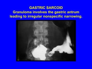 GASTRIC SARCOID Granuloma involves the gastric antrum leading to irregular nonspecific narrowing.