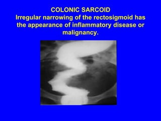 COLONIC SARCOID Irregular narrowing of the rectosigmoid has the appearance of inflammatory disease or malignancy.