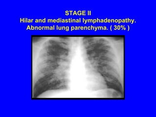  ACE levels tested regularly to check the severity of the disease and to monitor the response to therapy.RadiographyCXR 3 classic patterns are seen.	Type 1- bilateral hilaradenopathy with no parenchymal abnormalities.	Type 2- bilateral hilaradenopathy with diffused parenchymal changes.	Type 3- diffused parenchymal changes without hilaradenopathy. 