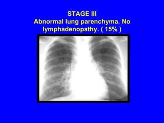 STAGE I Thoracic lymphadenopathy. Normal lung parenchyma. (50%)