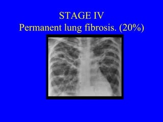 STAGE II Hilar and mediastinal lymphadenopathy. Abnormal lung parenchyma. ( 30% )