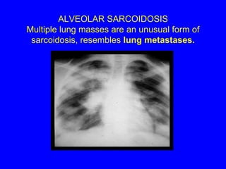 STAGE IV Permanent lung fibrosis. (20%)