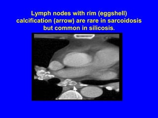 Lung Function TestLung function abnormalities for interstitial lung disease with decreased lung volumes and diffusing capacities