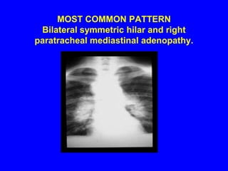Radiography“Egg shell” calcification of hilar nodesPlural effusionsCavitationsAtelectasisPneumothoraxCardiomegaly