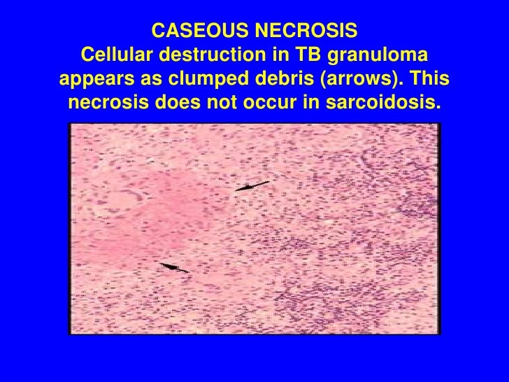 Sarcoidosis