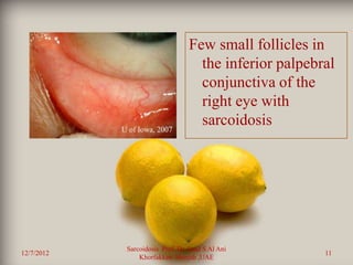 Few small follicles in
            •
                                       the inferior palpebral
                                       conjunctiva of the
                                       right eye with
                                       sarcoidosis




                Sarcoidosis Prof. Dr. Saad S Al Ani
12/7/2012                                                  11
                    Khorfakkan .Sharjah ,UAE
 