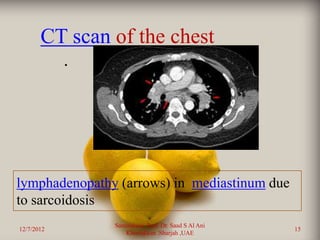 CT scan of the chest
            •




lymphadenopathy (arrows) in mediastinum due
to sarcoidosis
                Sarcoidosis Prof. Dr. Saad S Al Ani
12/7/2012                                             15
                    Khorfakkan .Sharjah ,UAE
 