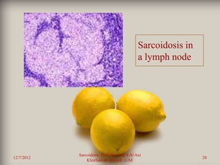 Sarcoidosis in
                                             a lymph node




            Sarcoidosis Prof. Dr. Saad S Al Ani
12/7/2012                                                     20
                Khorfakkan .Sharjah ,UAE
 