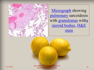 Micrograph showing
                                 pulmonary sarcoidosis
                                 with granulomas witha
                                  steroid bodies, H&E
                                          stain




            Sarcoidosis Prof. Dr. Saad S Al Ani
12/7/2012                                            22
                Khorfakkan .Sharjah ,UAE
 