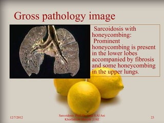 Gross pathology image
                                      Sarcoidosis with
                                     honeycombing:
                                      Prominent
                                     honeycombing is present
                                     in the lower lobes
                                     accompanied by fibrosis
                                     and some honeycombing
                                     in the upper lungs.




            Sarcoidosis Prof. Dr. Saad S Al Ani
12/7/2012                                                 23
                Khorfakkan .Sharjah ,UAE
 