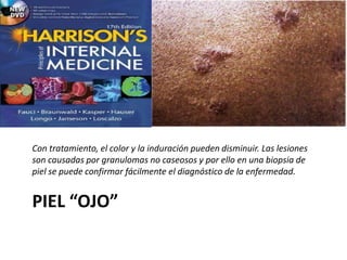 PIEL “OJO”
Con tratamiento, el color y la induración pueden disminuir. Las lesiones
son causadas por granulomas no caseosos y por ello en una biopsia de
piel se puede confirmar fácilmente el diagnóstico de la enfermedad.
 