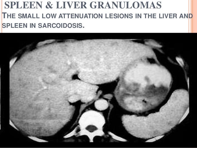 Sarcoidosis