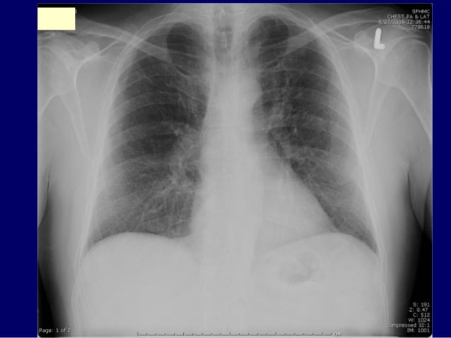 Cardiac Sarcoidosis Natural Treatment Cardiac Sarcoidosis Natural Treatment