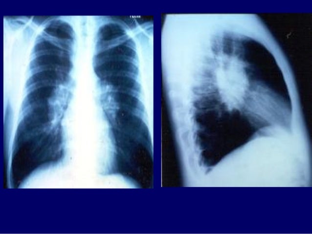 Nephrocalcinosis Natural Treatment Nephrocalcinosis Natural Treatment