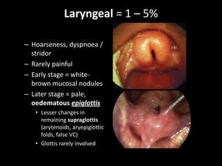 Laryngeal = 1 – 5%
– Hoarseness, dyspnoea /
stridor
– Rarely painful
– Early stage = whitebrown mucosal nodules
– Later stage = pale,
oedematous epiglottis
• Lesser changes in
remaining supraglottis
(arytenoids, aryepiglottic
folds, false VC)
• Glottis rarely involved

 