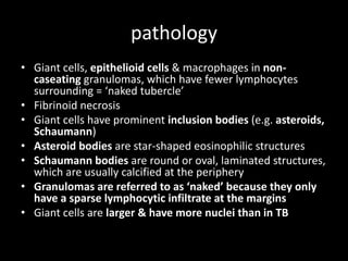 pathology
• Giant cells, epithelioid cells & macrophages in noncaseating granulomas, which have fewer lymphocytes
surrounding = ‘naked tubercle’
• Fibrinoid necrosis
• Giant cells have prominent inclusion bodies (e.g. asteroids,
Schaumann)
• Asteroid bodies are star-shaped eosinophilic structures
• Schaumann bodies are round or oval, laminated structures,
which are usually calcified at the periphery
• Granulomas are referred to as ‘naked’ because they only
have a sparse lymphocytic infiltrate at the margins
• Giant cells are larger & have more nuclei than in TB

 