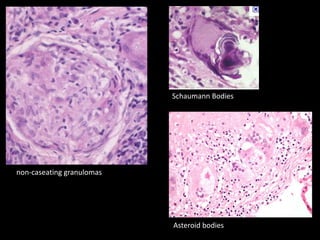 Schaumann Bodies

non-caseating granulomas

Asteroid bodies

 