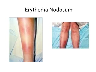 Erythema Nodosum
 