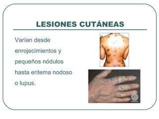 LESIONES CUTÁNEAS
Varían desde
enrojecimientos y
pequeños nódulos
hasta eritema nodoso
o lupus.
 