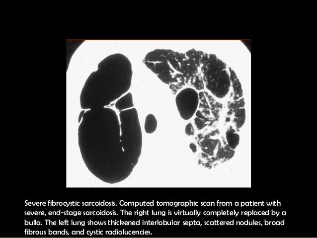 Sarcoidosis