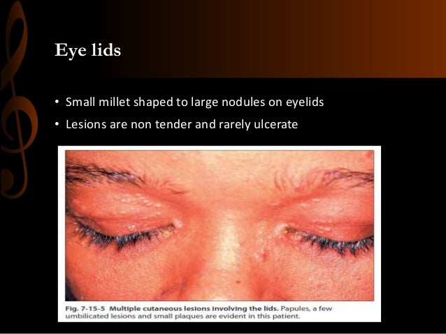 OCULAR SARCOIDOSIS
