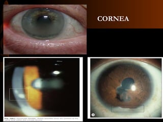 CORNEA
 