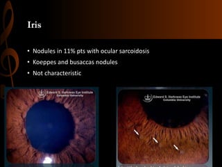 Iris
• Nodules in 11% pts with ocular sarcoidosis
• Koeppes and busaccas nodules
• Not characteristic
 