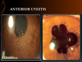 ANTERIOR UVEITIS
 