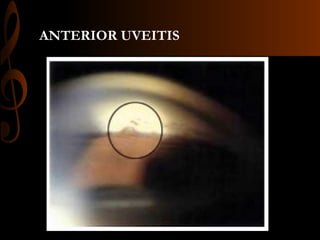 ANTERIOR UVEITIS
 