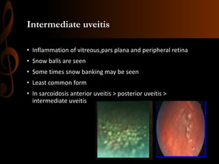 Intermediate uveitis
• Inflammation of vitreous,pars plana and peripheral retina
• Snow balls are seen
• Some times snow banking may be seen
• Least common form
• In sarcoidosis anterior uveitis > posterior uveitis >
intermediate uveitis
 