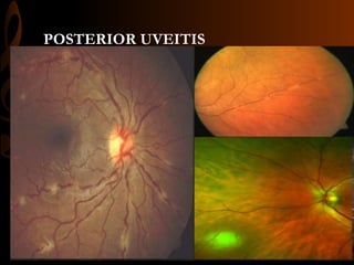 POSTERIOR UVEITIS
 