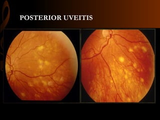 POSTERIOR UVEITIS
 