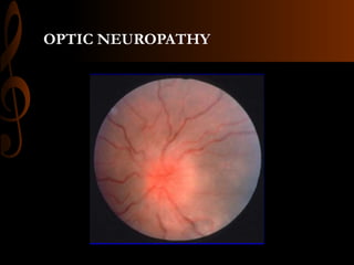 OPTIC NEUROPATHY
 