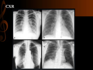 CXR
 