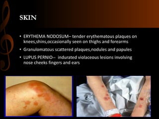 SKIN
• ERYTHEMA NODOSUM– tender erythematous plaques on
knees,shins,occasionally seen on thighs and forearms
• Granulomatous scattered plaques,nodules and papules
• LUPUS PERNIO-- indurated violaceous lesions involving
nose cheeks fingers and ears
 