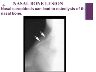 + NASAL BONE LESION
Nasal sarcoidosis can lead to osteolysis of the
nasal bone.
 