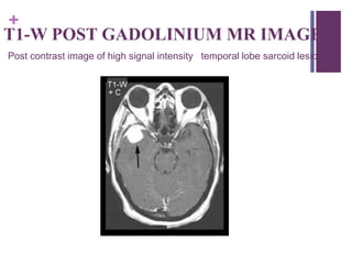 +
T1-W POST GADOLINIUM MR IMAGE
Post contrast image of high signal intensity temporal lobe sarcoid lesion
 