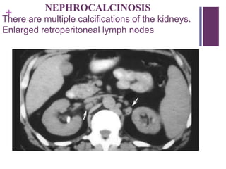 +
NEPHROCALCINOSIS
There are multiple calcifications of the kidneys.
Enlarged retroperitoneal lymph nodes
 