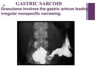 + GASTRIC SARCOID
Granuloma involves the gastric antrum leading to
irregular nonspecific narrowing.
 