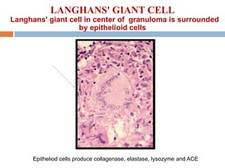 LANGHANS' GIANT CELL
Langhans' giant cell in center of granuloma is surrounded
by epithelioid cells
Epitheliod cells produce collagenase, elastase, lysozyme and ACE
 