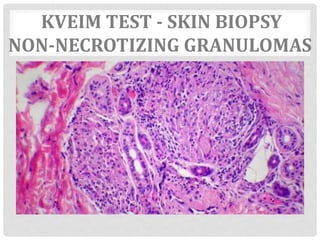 KVEIM TEST - SKIN BIOPSY
NON-NECROTIZING GRANULOMAS
 