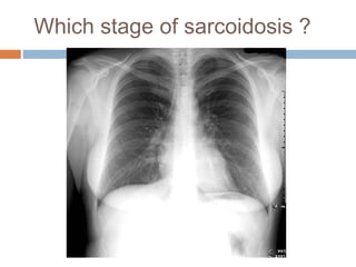 Which stage of sarcoidosis ?
 