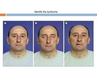 Identify the syndrome
 