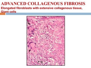 ADVANCED COLLAGENOUS FIBROSIS
Elongated fibroblasts with extensive collagenous tissue,
Giant cells
 