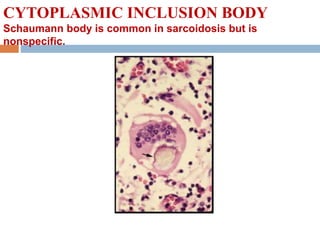 CYTOPLASMIC INCLUSION BODY
Schaumann body is common in sarcoidosis but is
nonspecific.
 